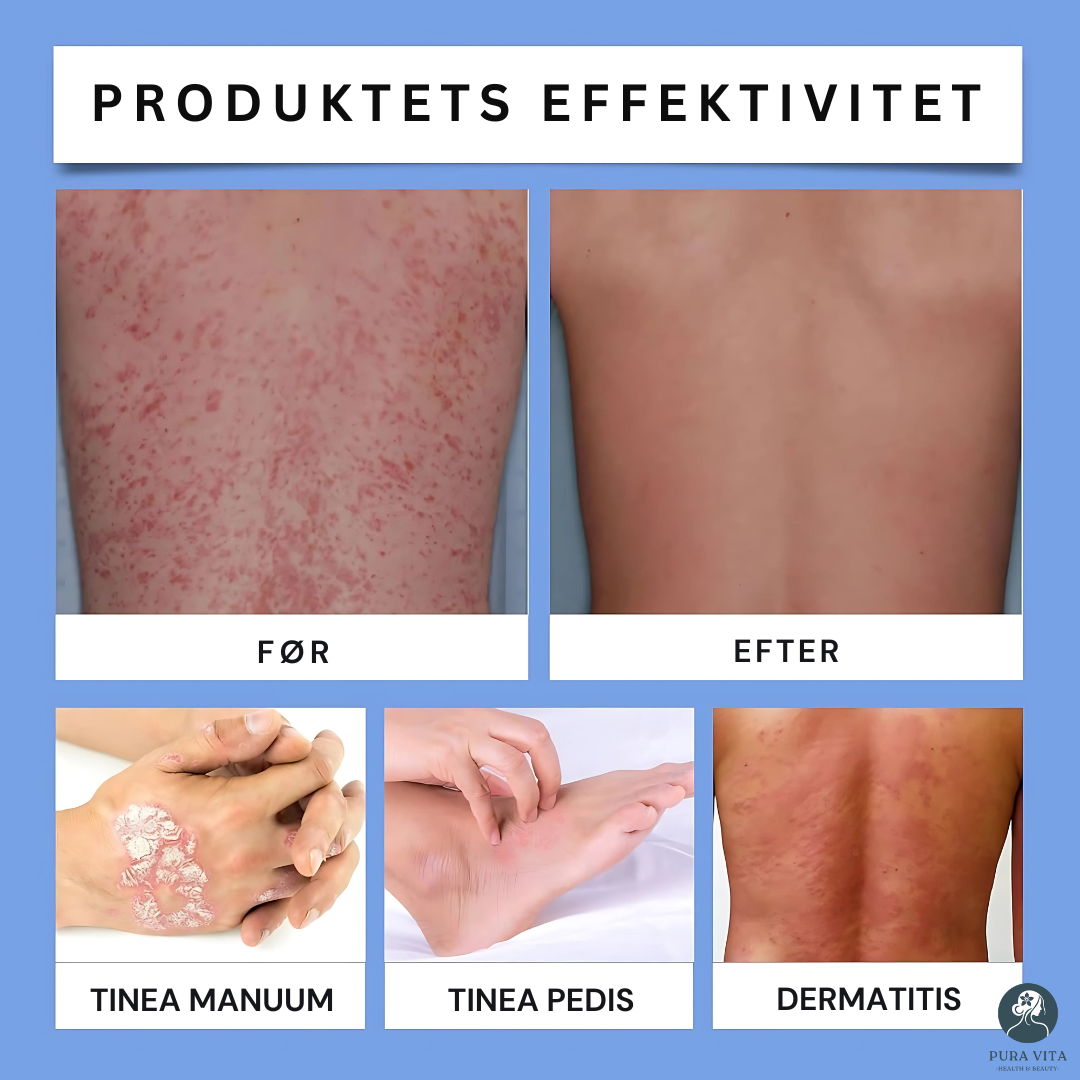PsoriaVita™ | Hurtig og Beroligende Lindring til Psoriasisudsat Hud